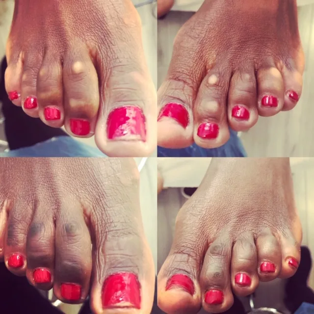 skin camouflage pigmentation on toes feet