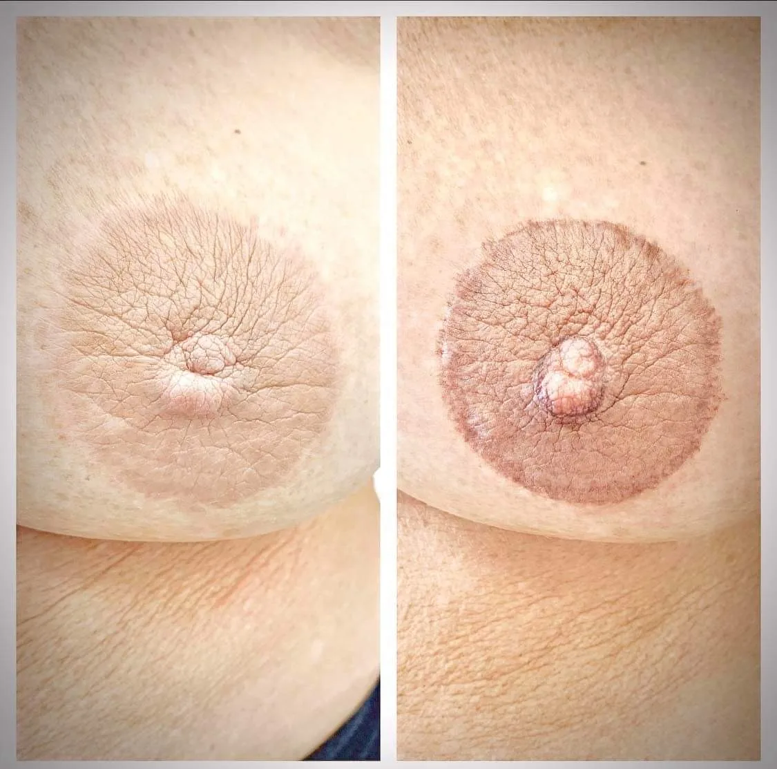 areola pigmentation London