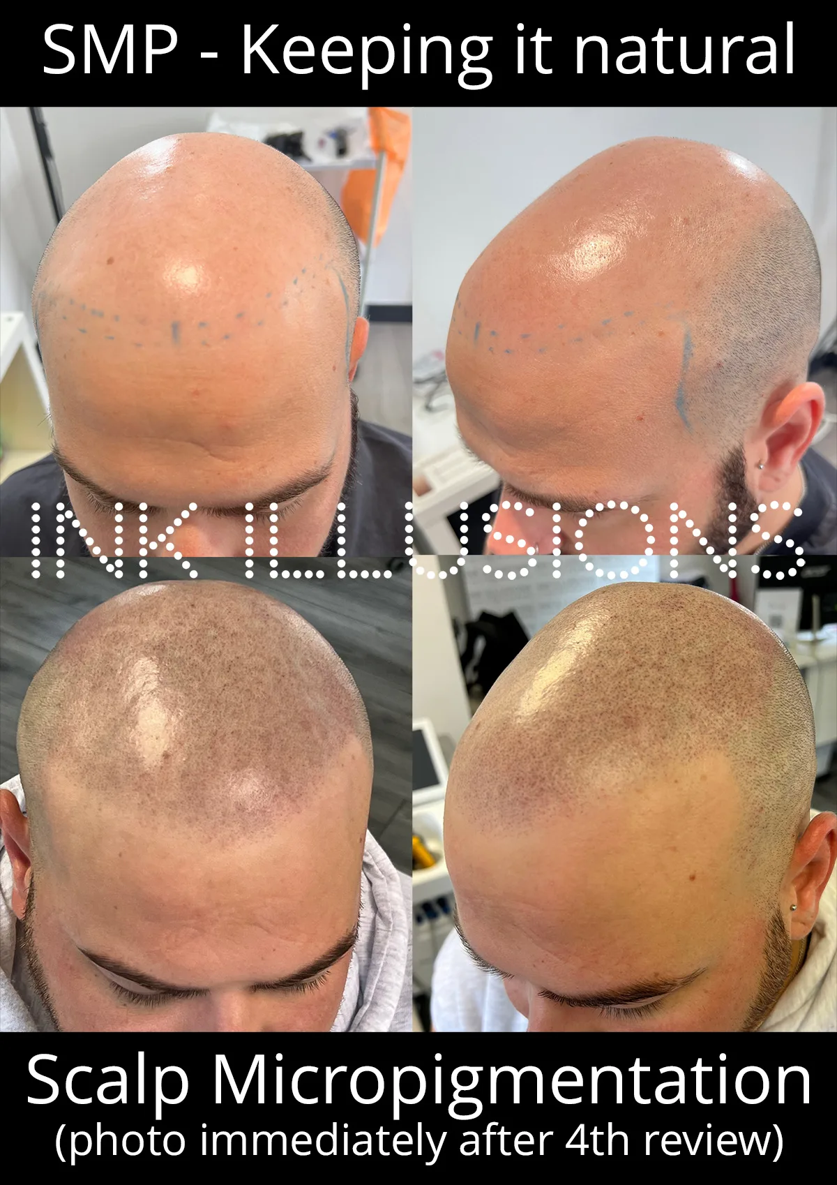 natural scalp micropigmentation london