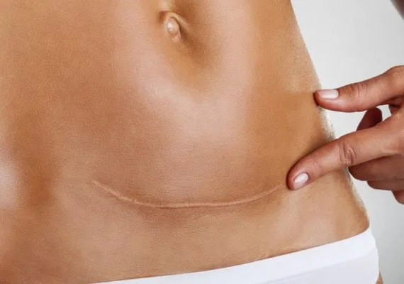 scar camouflage tattoo treatment