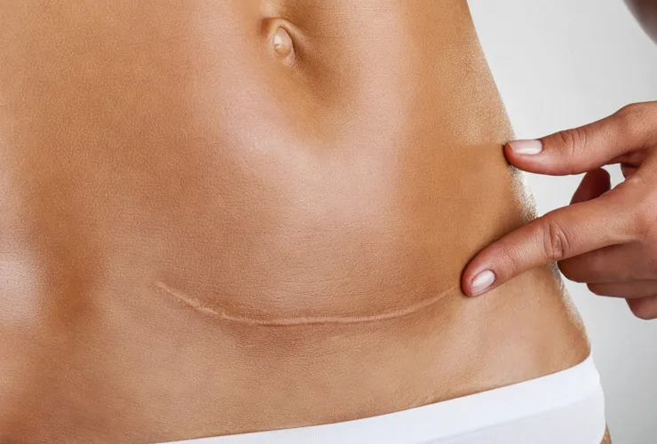 scar camouflage tattoo treatment