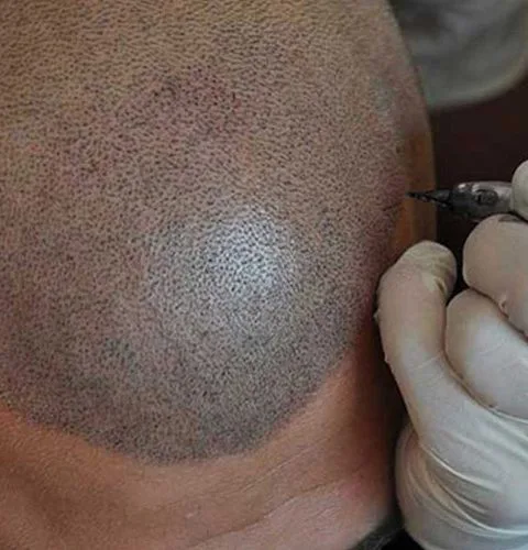 smp scalp tattoo london