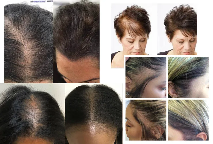 women thinning hair scalp micropigmentation density