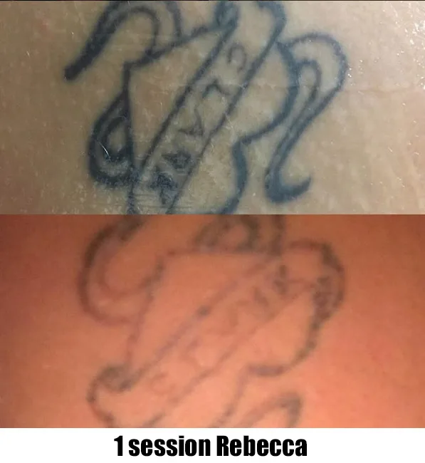 Removing Tattoo