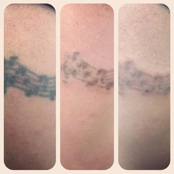 Laser Tattoo Removal