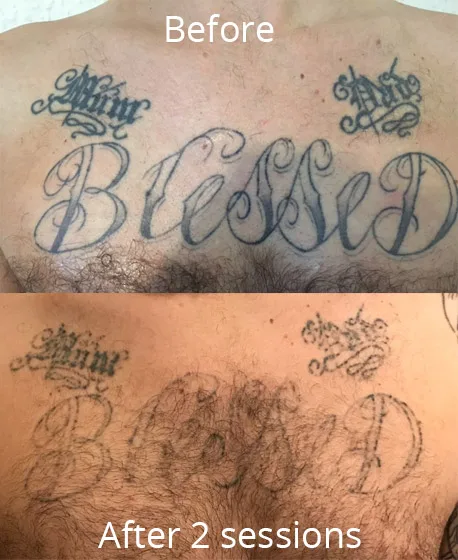 Laser Tattoo Removal London & Essex