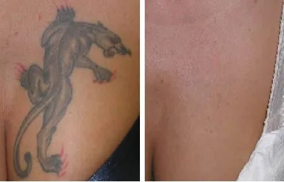 Laser Tattoo Removal London & Essex