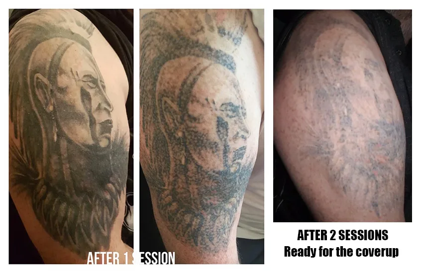 Tattoo Removing