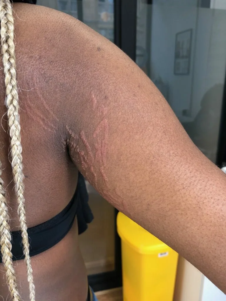 Scar & Brazilian Stretch Mark Tattoo Camouflage FAQs