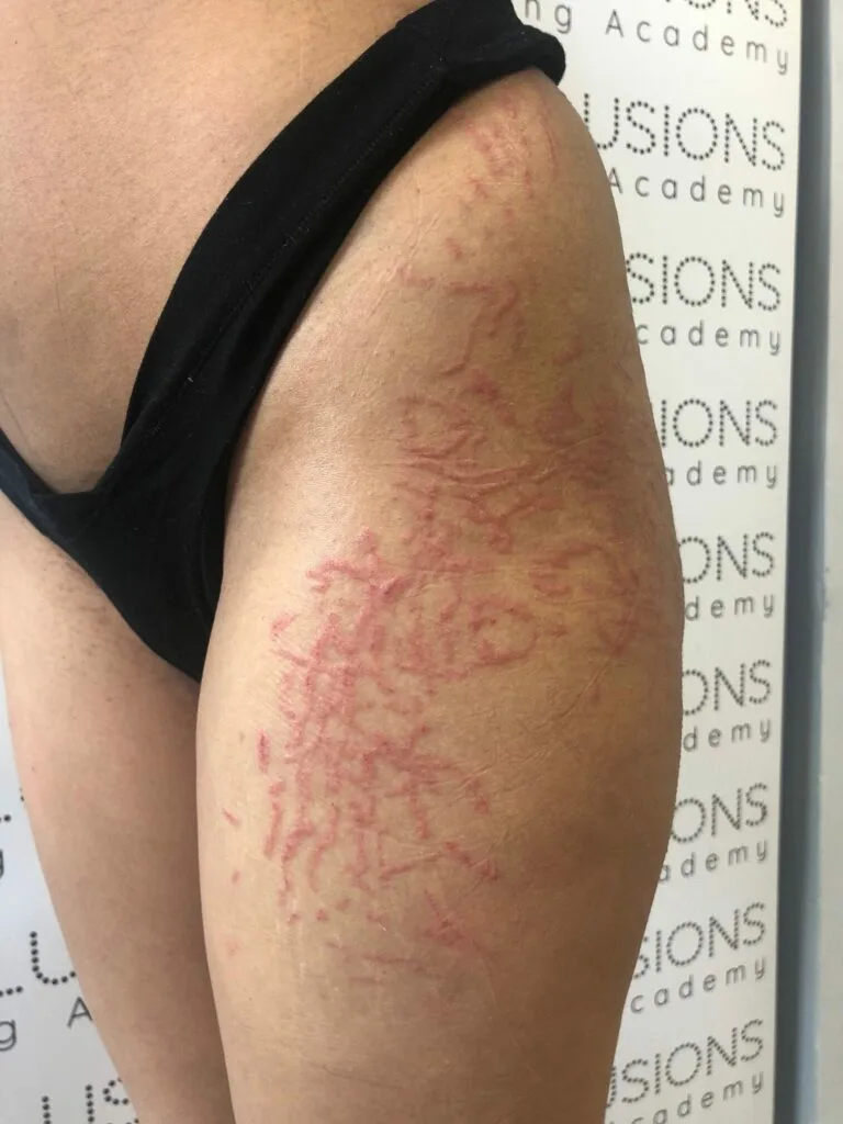 MCA needling straight after, Scar & Brazilian Stretch Mark Tattoo Camouflage FAQs