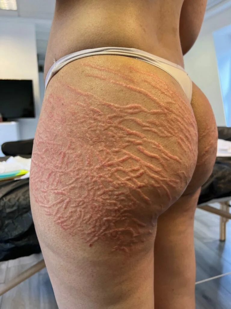 Scar & Brazilian Stretch Mark Tattoo Camouflage FAQs