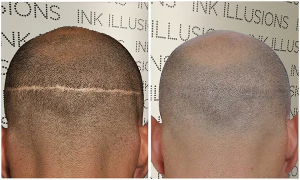 scalp micropigmentation london