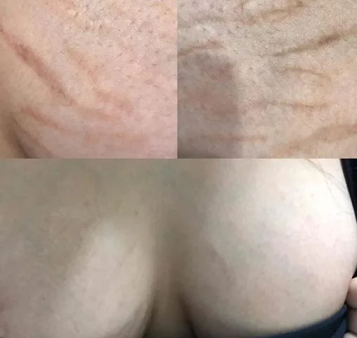 breast stretch marks camouflage