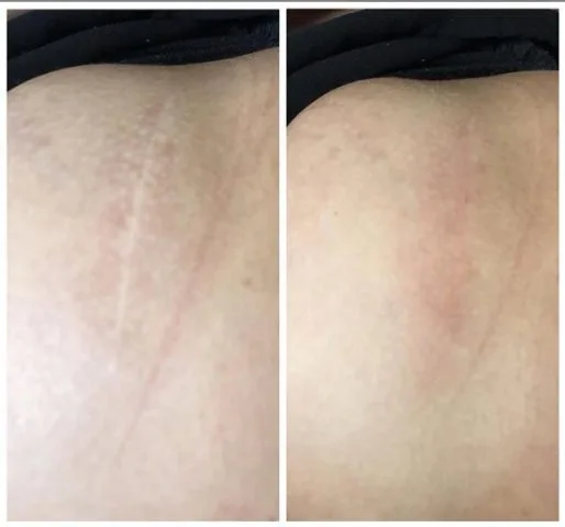scar camouflage with tattoo ink