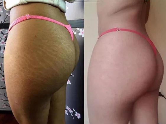 Image credit Novique Studio, Sweden - stretch mark camouflage by skin tone tattoo ink