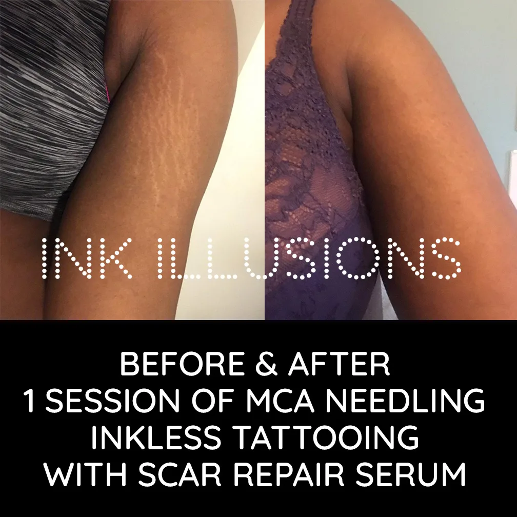 dark skin stretch marks treatment before after