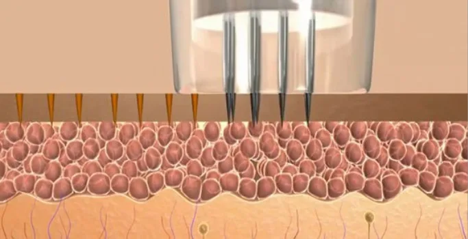 MCA NEEDLING CAUSES CHANNELS IN SKINQ
