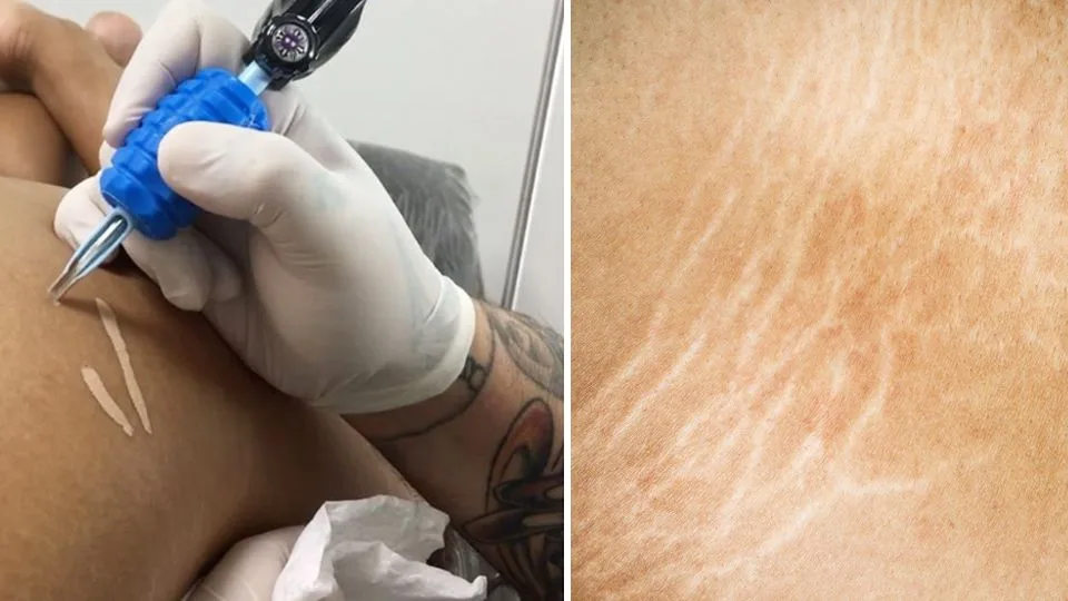 stretch mark tattoo camouflage London