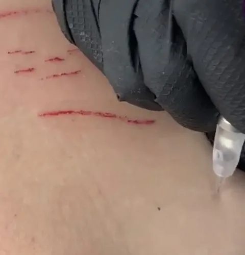 dry tattooing stretch marks treatment