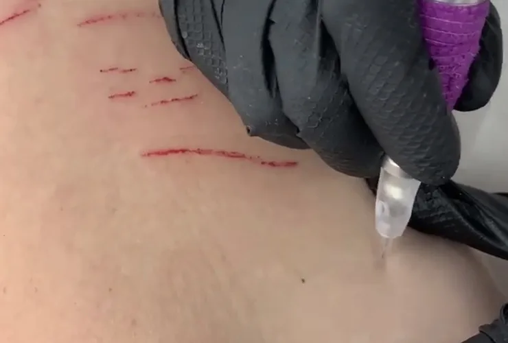 dry tattooing stretch marks treatment