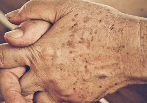 skin laser pigmentation removal