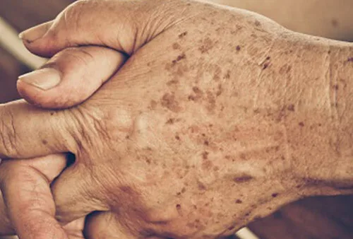 skin laser pigmentation removal