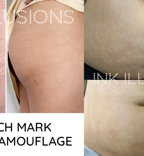 should you tattoo stretch marks