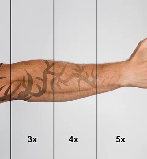 laser tattoo removal in London