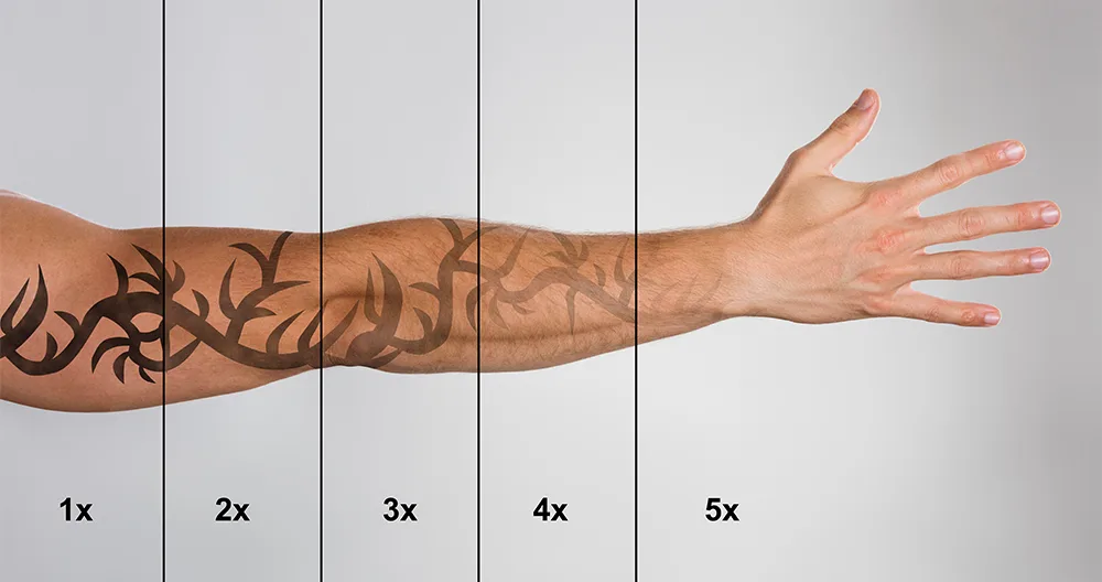 laser tattoo removal in London