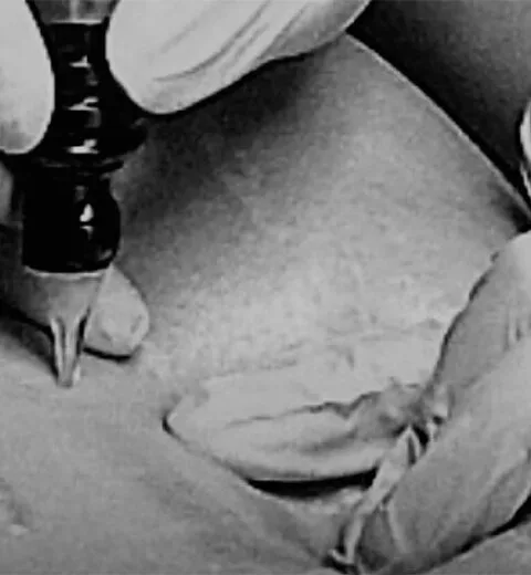 MCA dry needling image