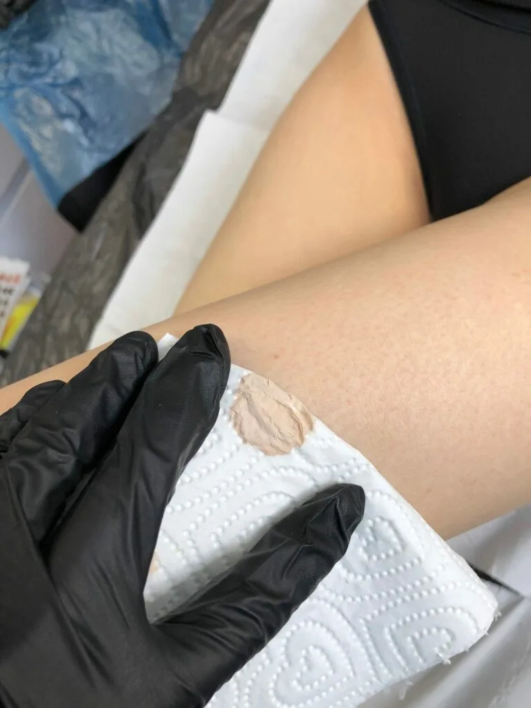 Scar & Stretch Mark micropigmentation
