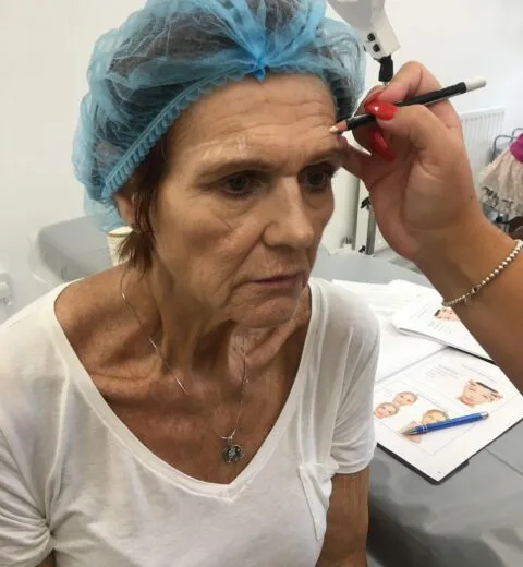 Basic Anti-wrinkle Injections