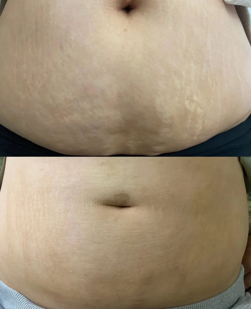 stretch marks on stomach MCA needling London