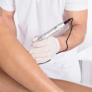 mca dry skin needling