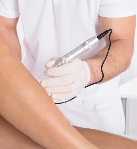 mca dry skin needling