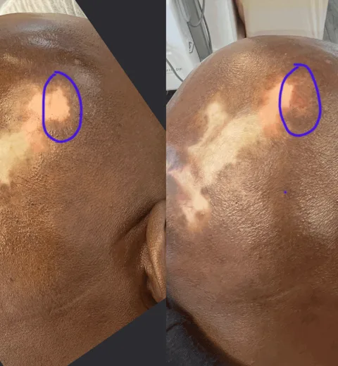 How do Vitiligo Tattoos Differ from Regular Tattoos