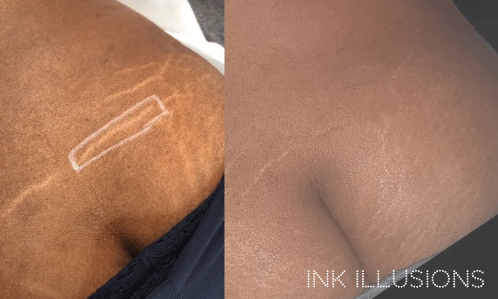 stretch mark treatment london