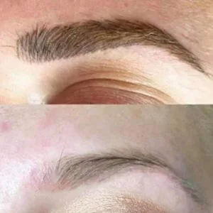 emergency eyebrow tattoo removal li-ft