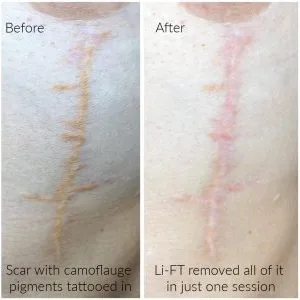 skin tone tattoo removal