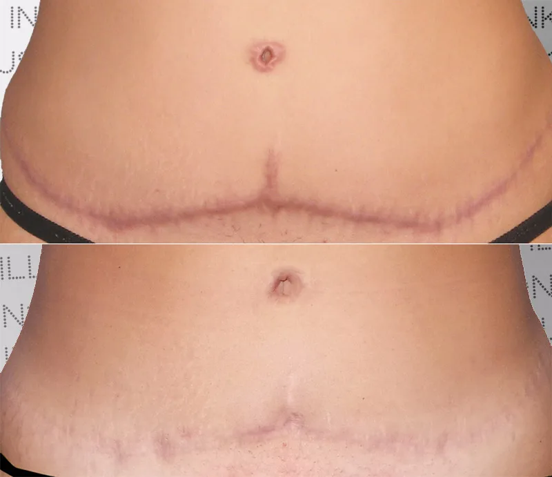 Stretch Marks removal