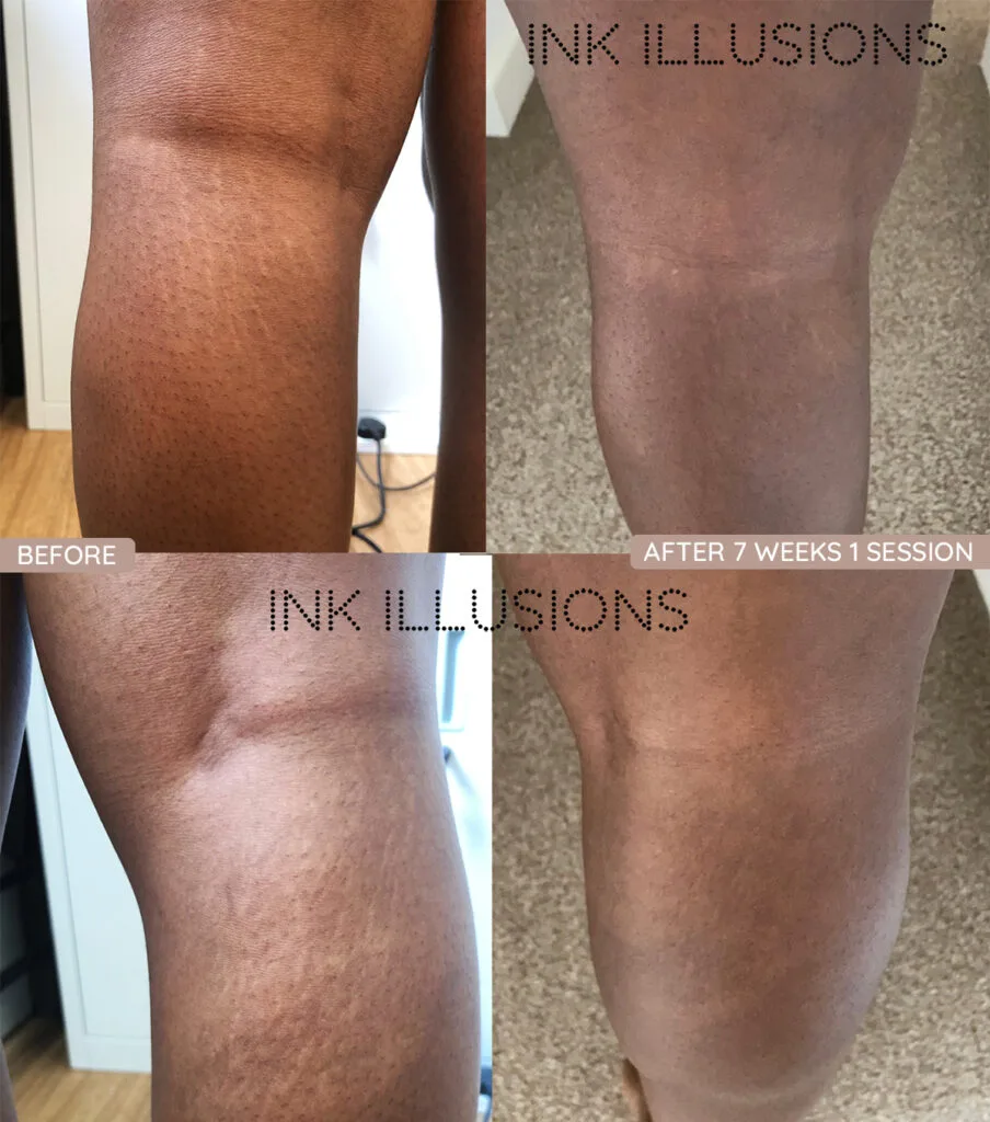 Inkless Stretch Mark and Scar Tattoo Camouflage Treatment