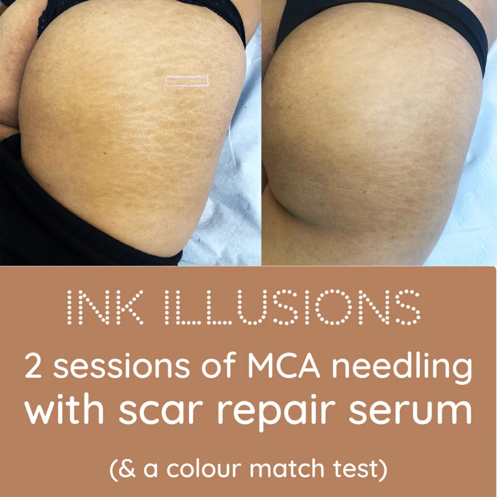 Collagen Induction Therapy Training - Inkless MCA needling, Microneedling, Dermaroller