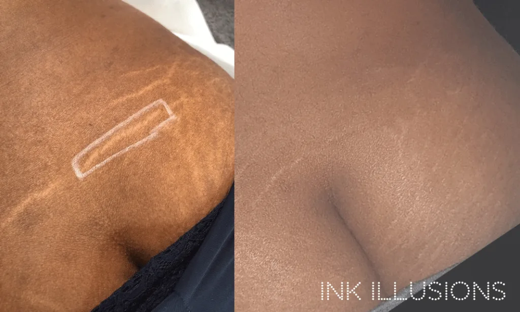 Stretch Mark