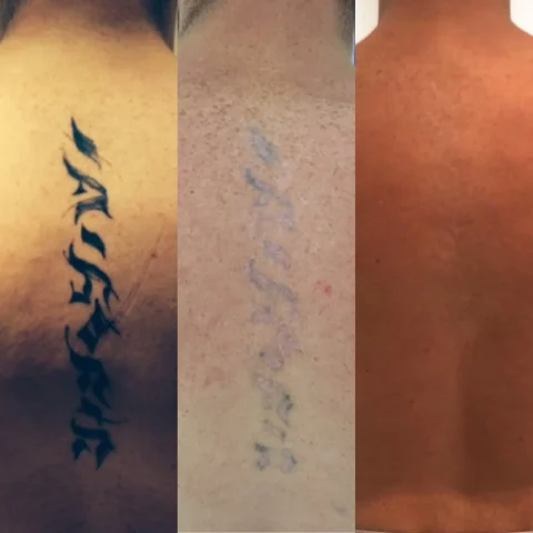 Rich after 2 sessions and 6 sessions of laser tattoo removal