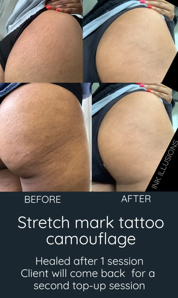 Inkless Stretch Mark and Scar Tattoo Camouflage Treatment