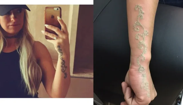 immediately after laser tattoo removal - the frosting is normal and will subside