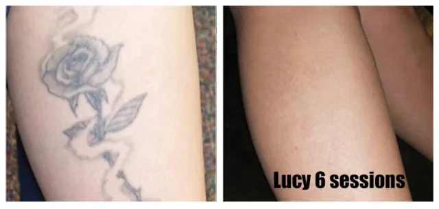 Lucy after 6 sessions of laser tattoo removal in Brentwood in Essex