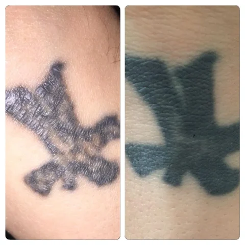 4 weeks after 1 session of laser tattoo removal in essex