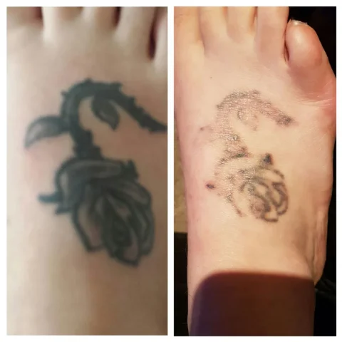 Sophie after 7 sessions of laser tattoo removal in Brentwood in Essex
