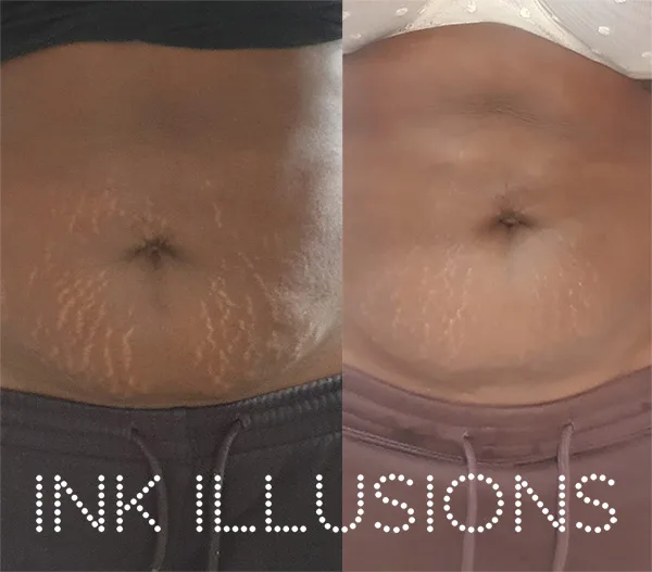 stomach strech mark treatment